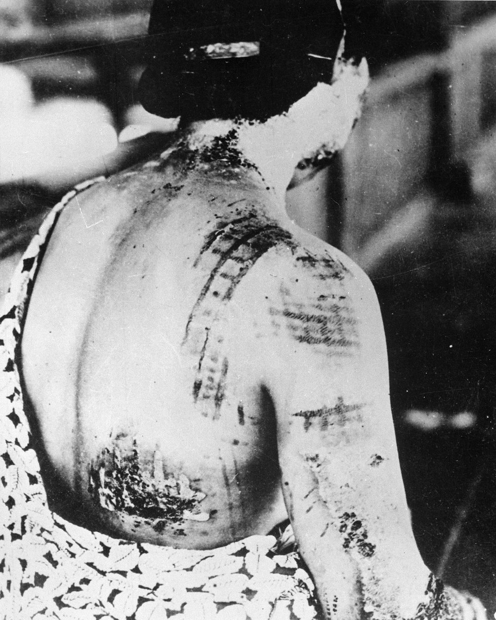 The_patient's_skin_is_burned_in_a_pattern_corresponding_to_the_dark_portions_of_a_kimono_-_NARA_-_519686.jpg.jpe